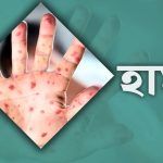 হাম ও উপসর্গে আরও এক শিশুর মৃত্যু