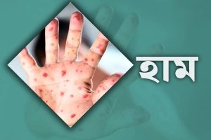 হাম ও উপসর্গে আরও এক শিশুর মৃত্যু